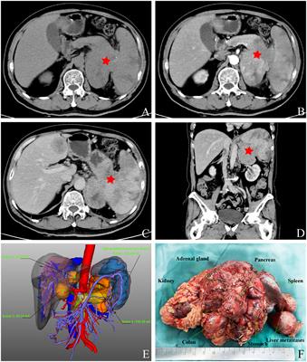 Multivisceral resection of nonfunctional pancreatic neuroendocrine neoplasm with nearby organ invasion: a case report